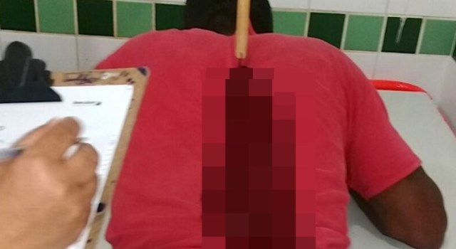 Faca fica encravada nas costas de criança de 11 anos na região de Sousa