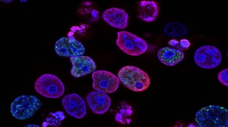 pesquisa descobre calcanhar de aquiles de cancer resistente a quimio