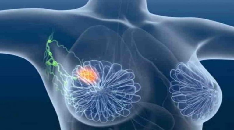 medicos descobrem novo tratamento para cancer de mama agressivo