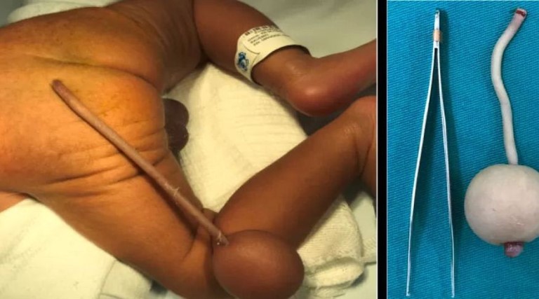 Caso raro: Bebê brasileiro nasce com cauda de 12 cm e bola de 4 cm na extremidade 1 bebe prematuro nasceu com um apendice de 12 centimetros que tinha uma bola na extremidade caso acont