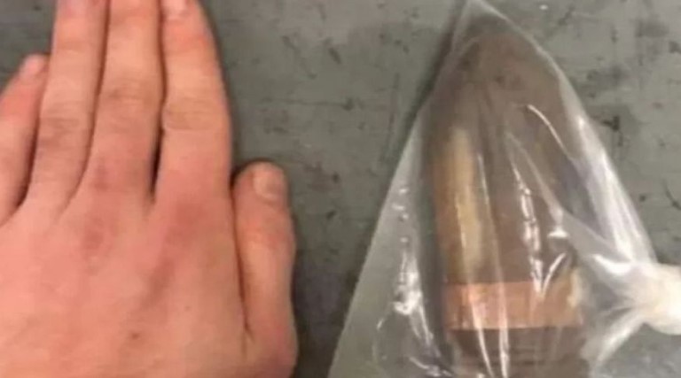 hospital aciona equipe antibomba para receber homem com bala de canhao no anus