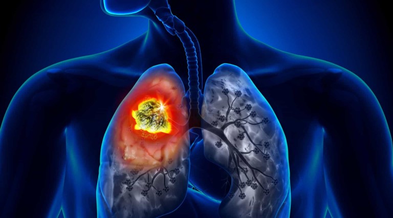 estudo-indica-para-sus-radioterapia-que-trata-cancer-de-pulmao-em-ate-5-sessoes