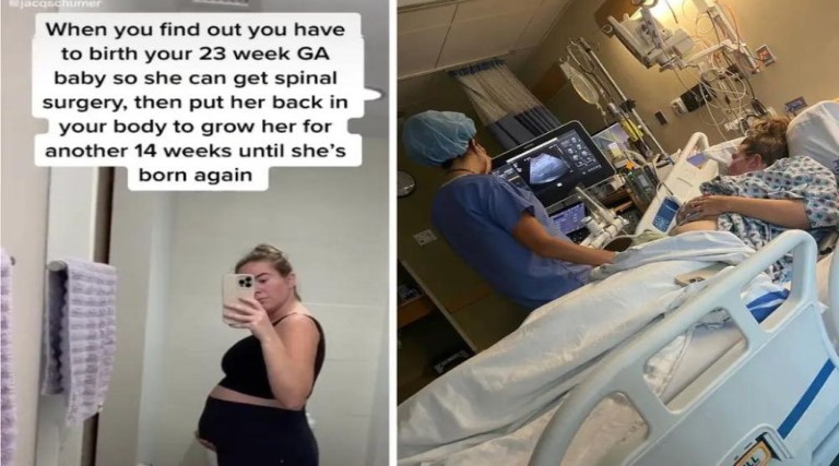 mae salva bebe cirurgia rara feto operado fora utero devolvido barriga