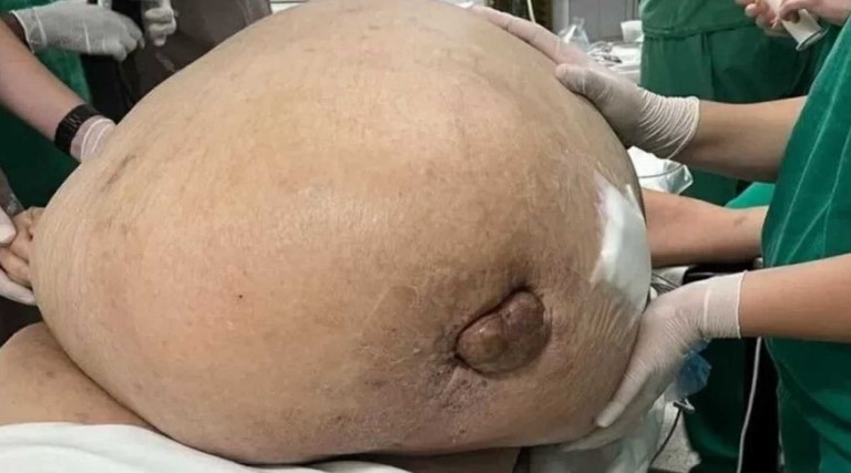 tumor com cerca de 46 kg e retirado de mulher em cirurgia de emergencia