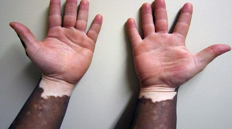 pomada com ruxolitinibe ameniza vitiligo em ate 75 diz estudo