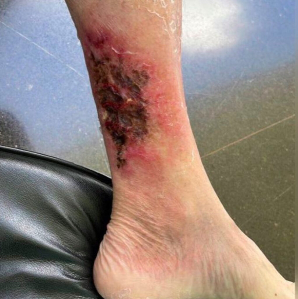 Carlos publica foto da perna de Bolsonaro com erisipela; veja 2 naom 638cecc3990ee