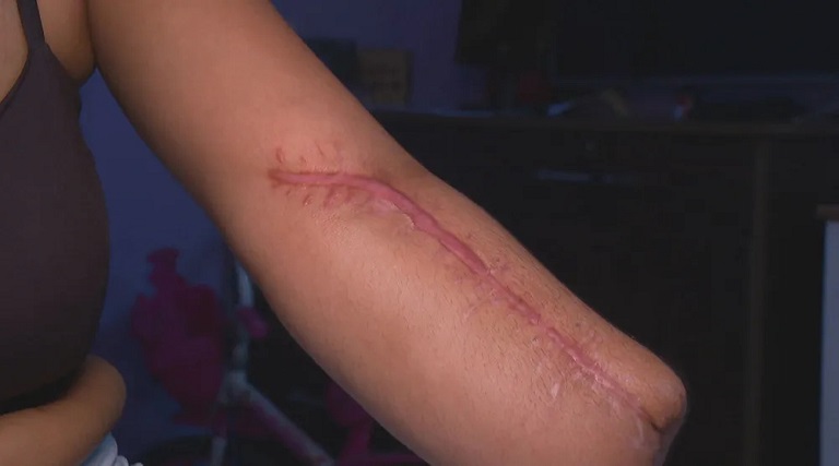 Mulher vai a hospital no Rio para dar à luz e sai com mão amputada 1 mulher vai a hospital no rio para dar a luz e sai com mao amputada