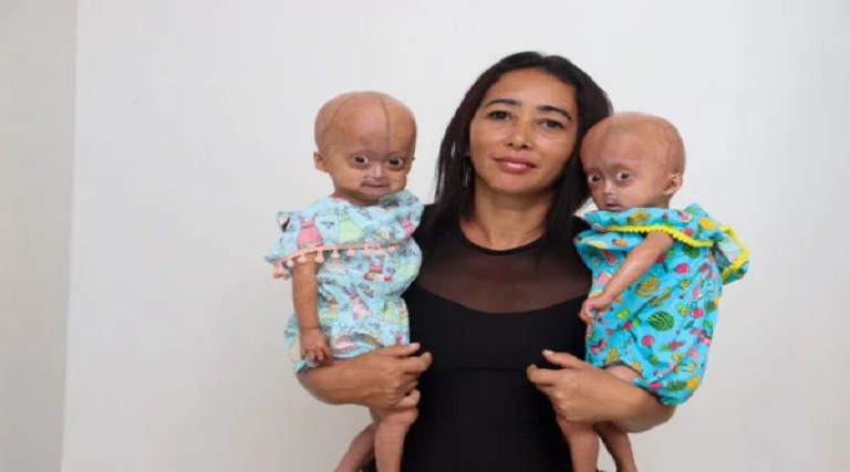 rarissimo-conheca-as-gemeas-brasileiras-com-sindrome-de-benjamin-button