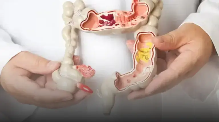 Proteína reduz tumor de câncer colorretal em 77% 1 Proteina reduz tumor de cancer colorretal em 77