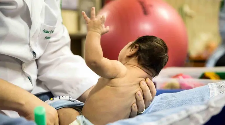 Crianças com Zika ganham auxílio do governo 1 Crianças com Zika ganham auxílio do governo