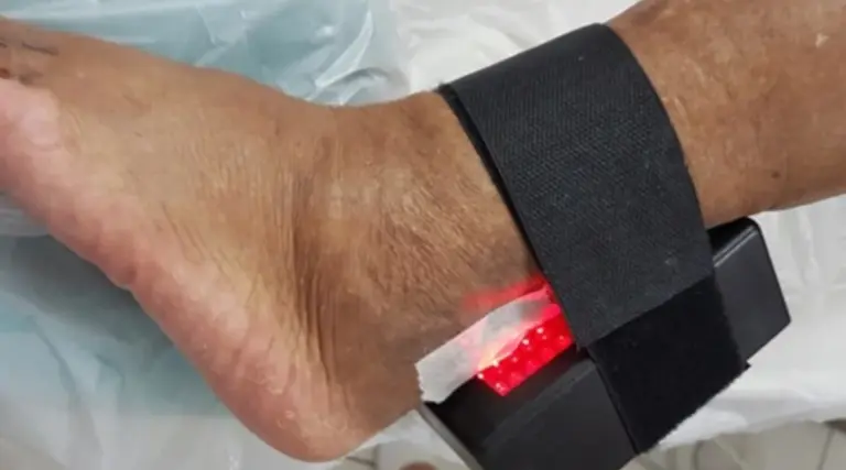 Diabetes: Invenção brasileira evita amputações 1 Diabetes: Invenção brasileira evita amputações