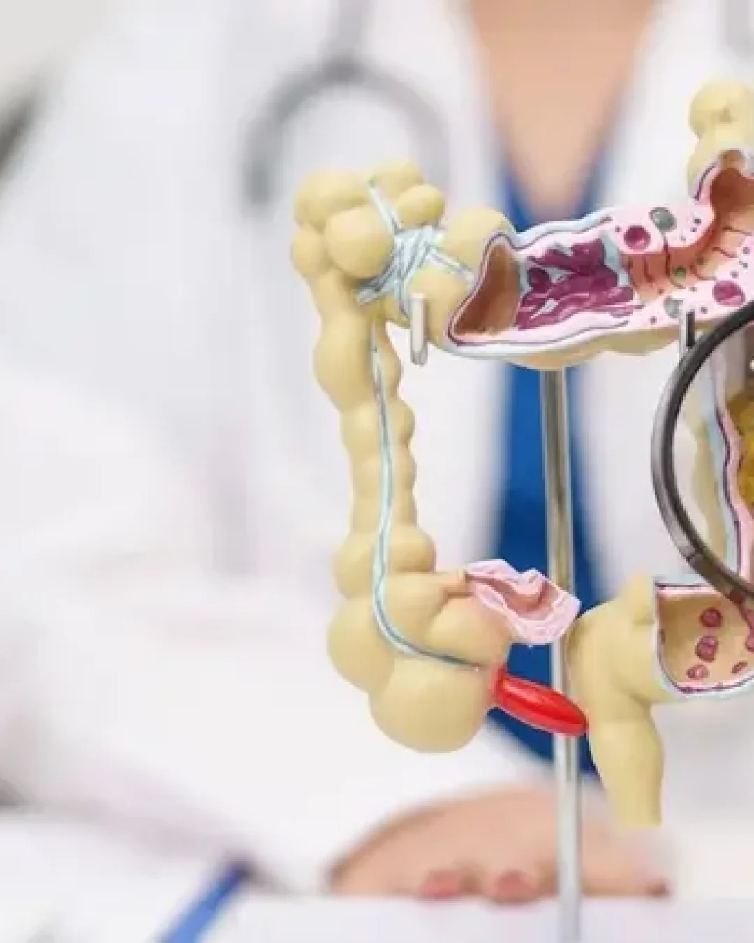 SUS passa a oferecer exame para detectar câncer de intestino precocemente